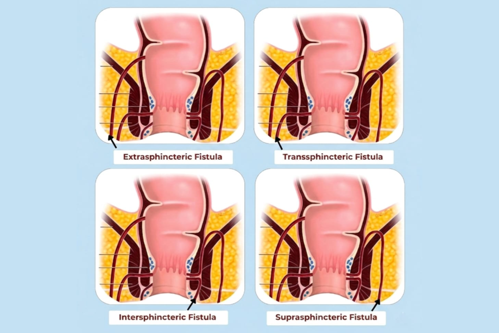 Types of anal fistula – intersphincteric, transsphincteric and suprasphincteric classification